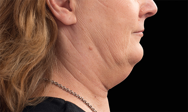 double chin reduction treatment coolsculpting Chester